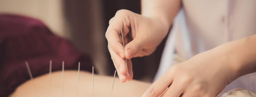 A practitioner is performing acupuncture by carefully inserting thin needles into a patient's back